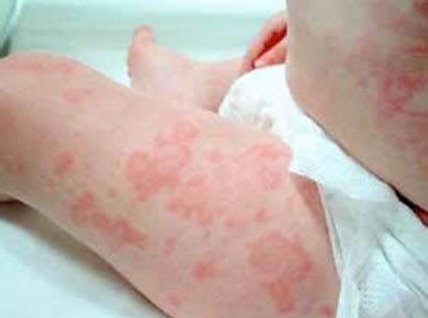 From viral infection rash to food sensitivities to the fever and rash toddlers can experience from roseola. Basics - Food Allergy Education