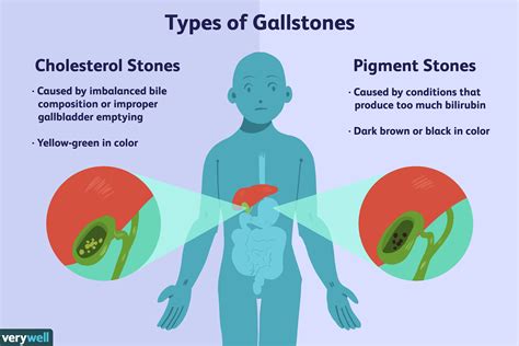 Gallstones Cholelithiasis Causes Symptoms Treatment