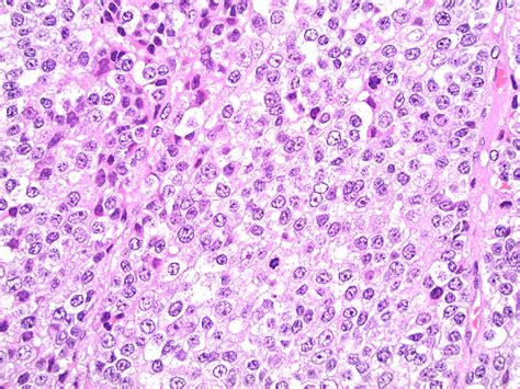 An Aggressive Case Of Adrenocortical Carcinoma Complicated By