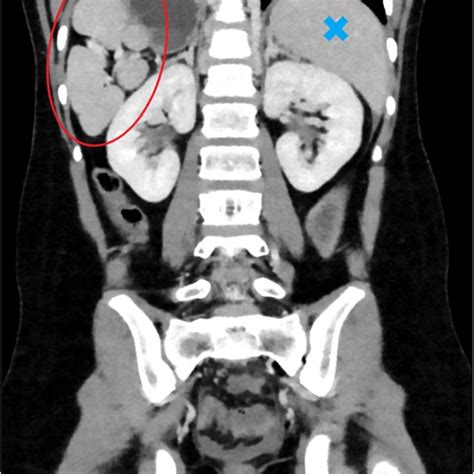 Ct Scan Of The Abdomen With Iv Contrast Demonstrating The Polysplenia
