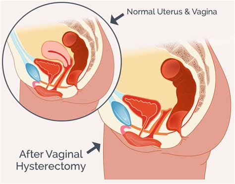 Hysterectomy Stacie Sumner