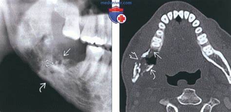 Рентгенограмма, КТ, МРТ при остеорадионекрозе челюсти Картинка - Рентгенограмма, КТ, МРТ при остеорадионекрозе челюсти