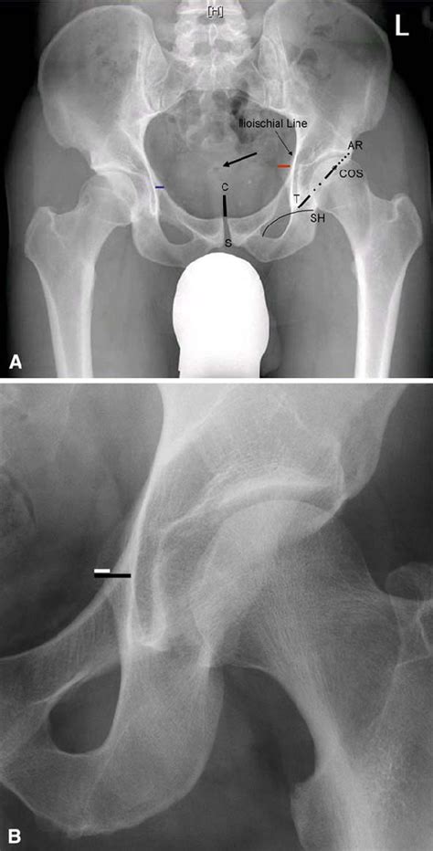 a b a a pelvic radiograph shows the measurements obtained symphysis download scientific