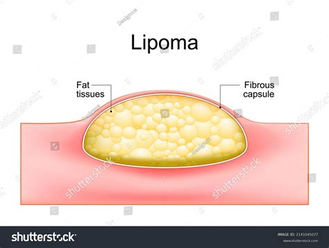 1233 Lipoma Images Stock Photos And Vectors Shutterstock