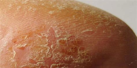 What Causes Scaly Or Flaking Skin