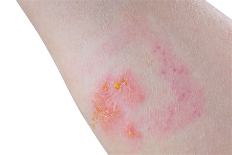 Poison Ivy Rash Clear Up These Common Childrens Skin Conditions