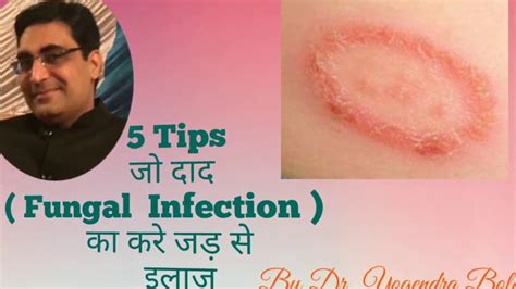 5 Tips To Cure Fungal Infection Tinea Completelyin Hindiby