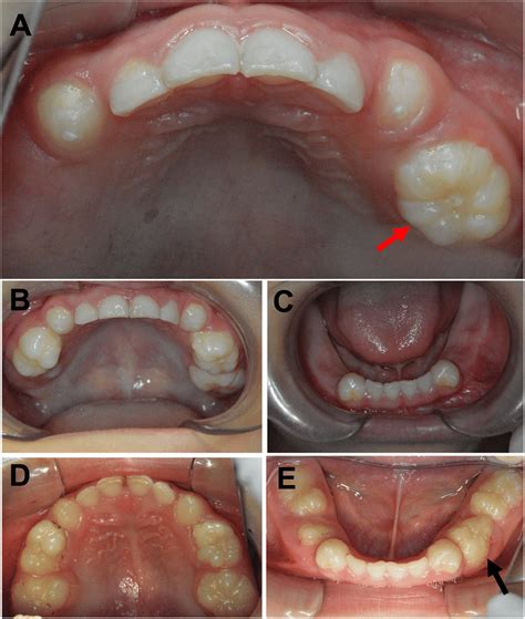 Intraoral Views Showed Abnormal Canines And Molars At 4 Year Old Age