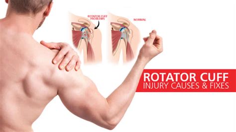 Rotator Cuff Injury Including Rotator Cuff Tear Rotator Cuff Bursitis