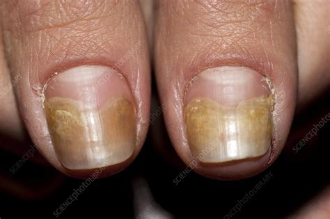 Fungal Nail Infection Stock Image C0070718 Science Photo Library