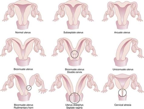 Congenital Anomalies And Benign Conditions Of The Uterine Corpus And Cervix Hacker And Moore S