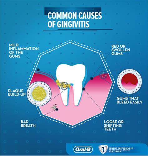 What Is Gingivitis Symptoms Causes And Treatments Oral B