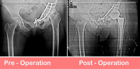 Total Hip Arthroplasty Dual Mobility Sant Parmanand Hospital