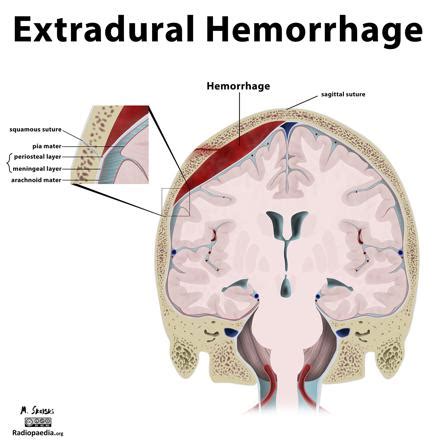 Extradural Hematoma Vs Subdural Hematoma Radiology Reference Article