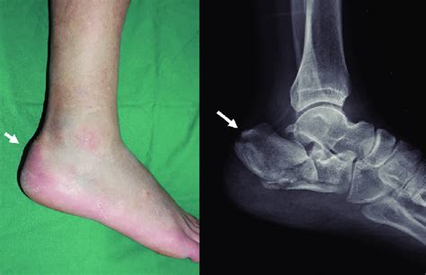 Displaced Fragment Causes Skin Tenting On The Posterior Heel Arrows
