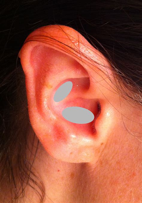 Ear Cartilages