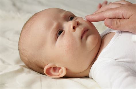 Baby Eczema How To Spot And Treat Eczema In Babies And Children