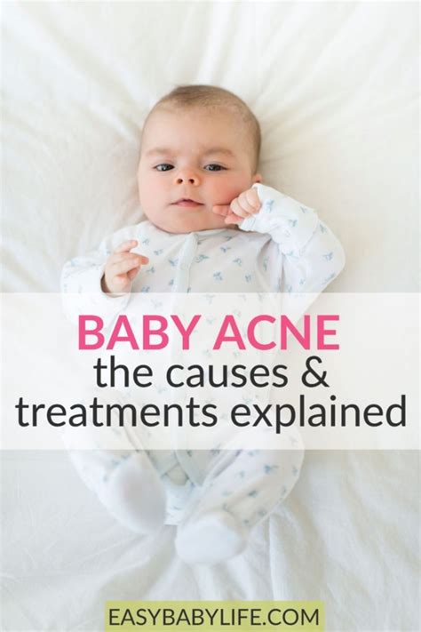 How To Get Rid Of Baby Acne What All Parents Should Know