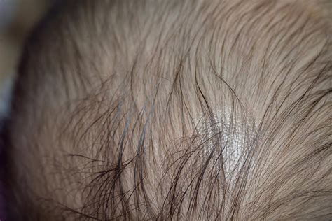 What Causes Itching Scalp And Thinning Hair