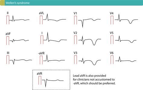 Figure 2 Wellens Syndrome Wellens Sign Ecg Learning