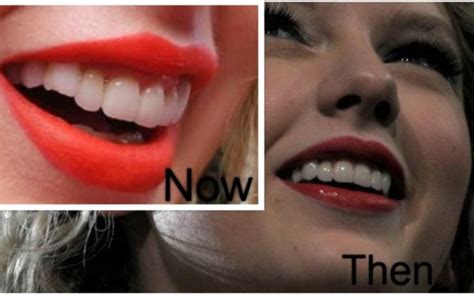 Taylor Swifts Teeth Before After Chipped Teeth And Veneers