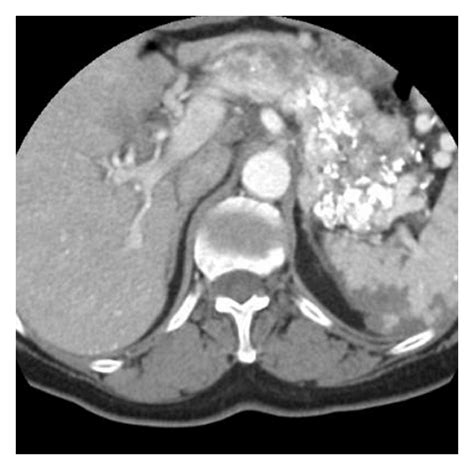 Contrast Enhanced Axial Ct Scan Through The Pancreas After The