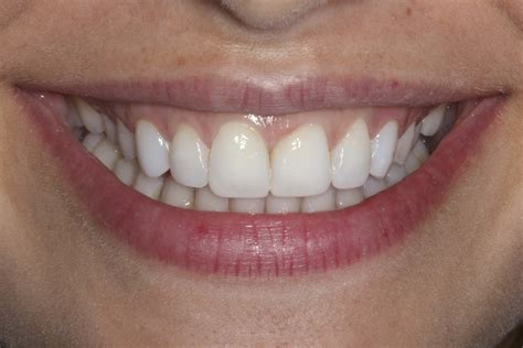 Colagem Composite Vs Porcelain Veneers Qual é Melhor Enlighten