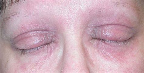 Eczema Eyelids