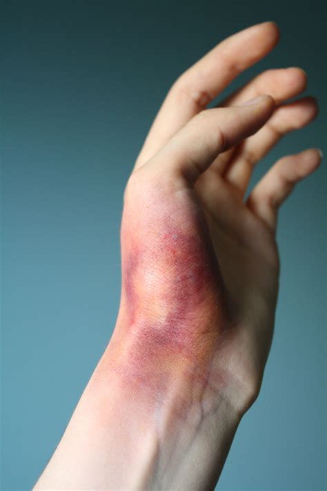 First Stage Of A Bruise Bruises Occur When Blood Vessels Break Due To