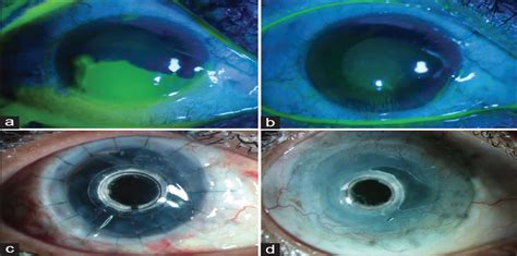Contact Lenses In Dry Eye Disease And Associated Ocular Surf