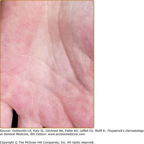 List 102 Images Palmar Erythema Red Palms Liver Disease Photos Updated