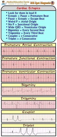 Cardiac Dysrhythmia Also Known As Arrhythmia And Irregular Heartbeat