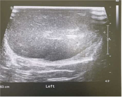 Testicular Ultrasound Shows A Diffuse Heterogeneous Left Testis With No Download Scientific