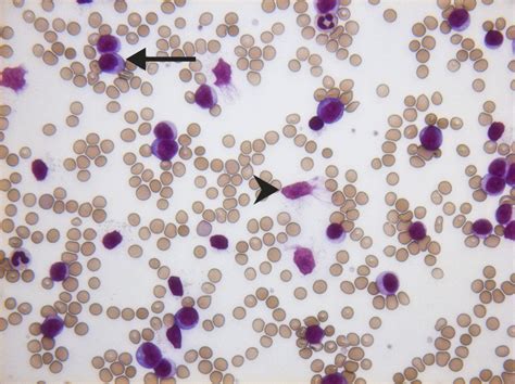 An Unusual Case Of Severe Anaemia And Lymphocytosis The Bmj
