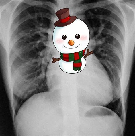 Total Anomalous Pulmonary Venous Connection X Ray Wikidoc
