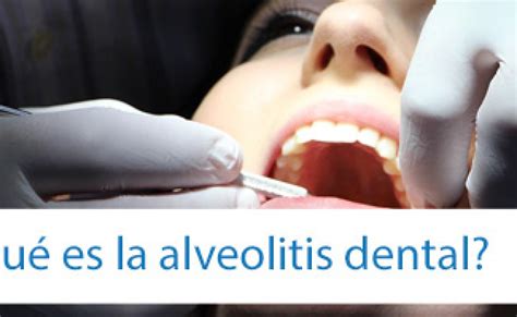 La Alveolitis Dental Diferentes Causas Tipos Y Tratamiento Otosection