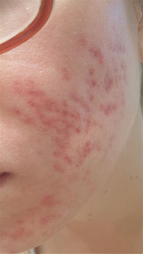 Skin Concerns Pih Scars Just Good Ole Acne Help R
