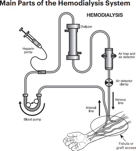 What Is Hemodialysis National Kidney Foundation