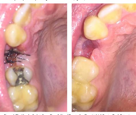 Figure 4 From Alveolar Osteitis Following Tooth Extraction Systematic