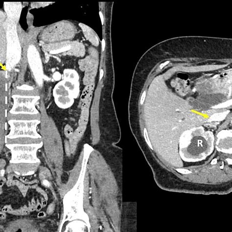 A Contrast Enhanced Ct Scan Of The Abdomen In Coronal Left And