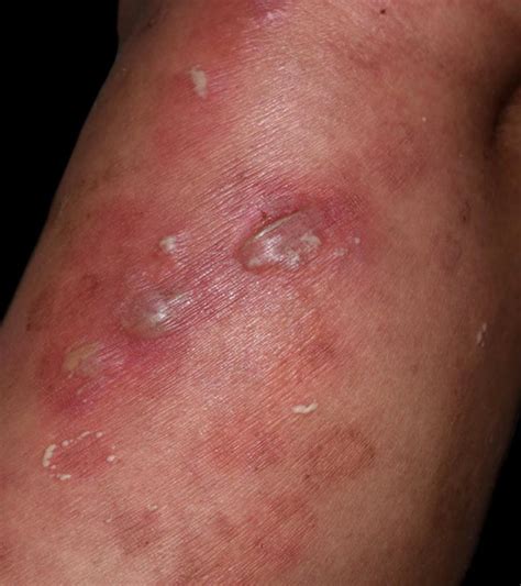 Vesicular Skin Lesions Causes Symptoms Diagnosis Treatment