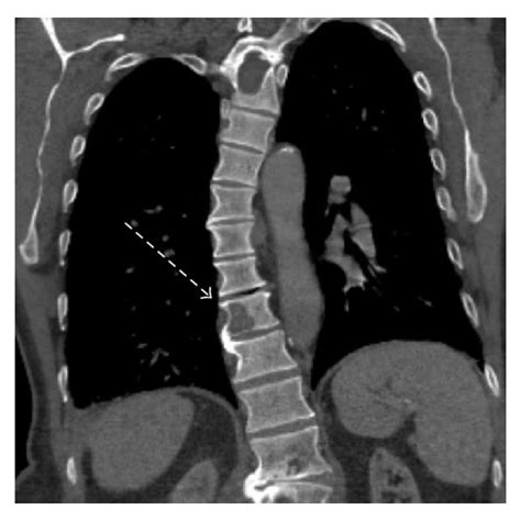 A Pretherapy Enlarged Left Supraclavicular Lymph Node B