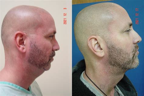 Chin Augmentation Before And After Photo Gallery San Jose Ca