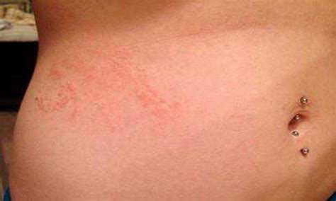 Scabies Rash Look Like And Causes9 Digest Ground