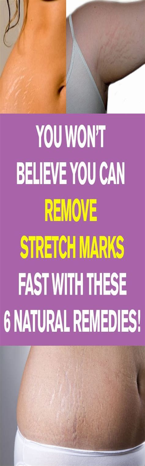 You Wont Believe You Can Remove Stretch Marks Fast With These 6 Natural Remedies Lets Tallk