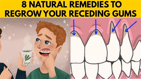 👅8 Easy Ways To Grow Back Your Receding Gums Naturally At Home Youtube