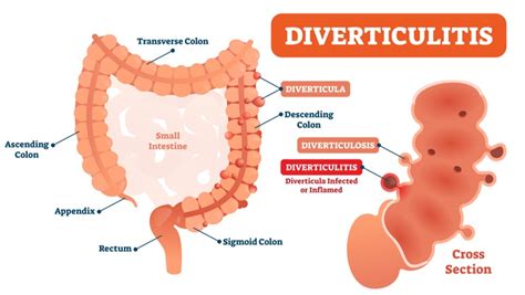 5 Symptoms Of Diverticulosis Entirely Health