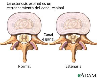 Fisioterapia Y Osteopat A Estenosis De Canal
