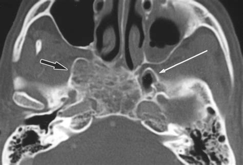 Fibrous Dysplasia Involving The Base Of The Skull Ajr