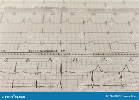 Electrocardiogram Strips With Cardiac Arrhythmias Ventricular Escape